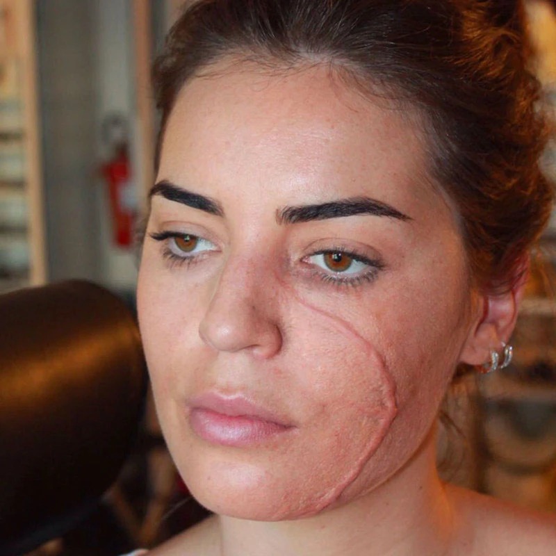 PROTESI CICATRICE LUNGA 4 PROTESI CICATRICE LUNGA - immagine 2