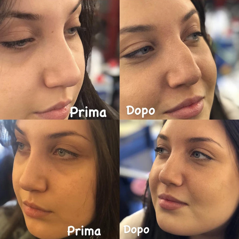 PROTESI SELLA NASO EX PUGILE 4 PROTESI SELLA NASO EX PUGILE - immagine 2