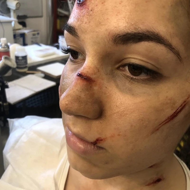 PROTESI TAGLIO SELLA NASO 4 PROTESI TAGLIO SELLA NASO - immagine 2