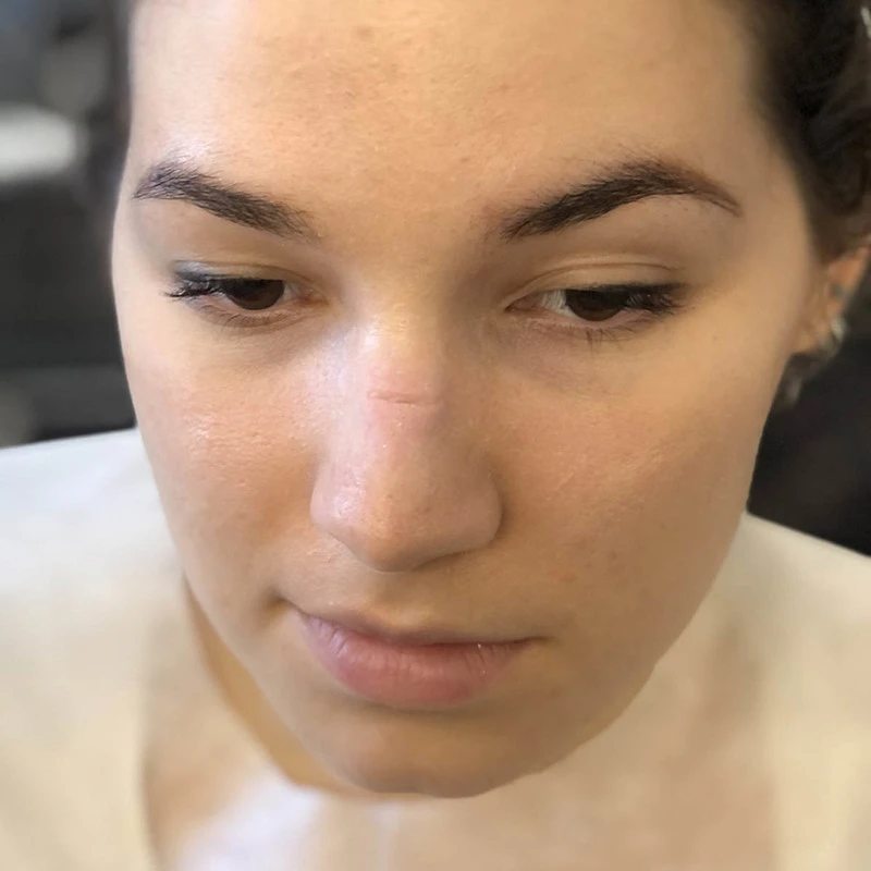 PROTESI TAGLIO SELLA NASO 5 PROTESI TAGLIO SELLA NASO - immagine 3