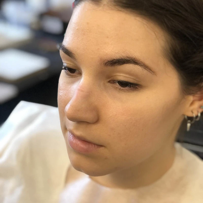 PROTESI TAGLIO SELLA NASO 6 PROTESI TAGLIO SELLA NASO - immagine 4