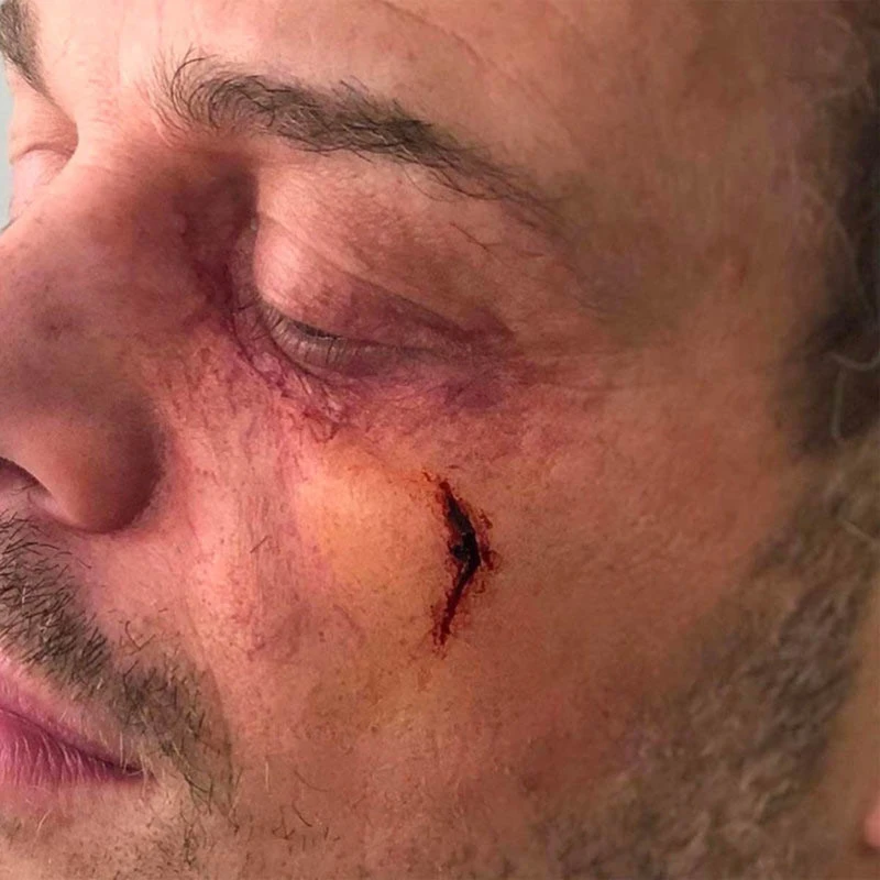 OCCHIO GONFIO Sinistro 4 OCCHIO GONFIO Sinistro - immagine 2