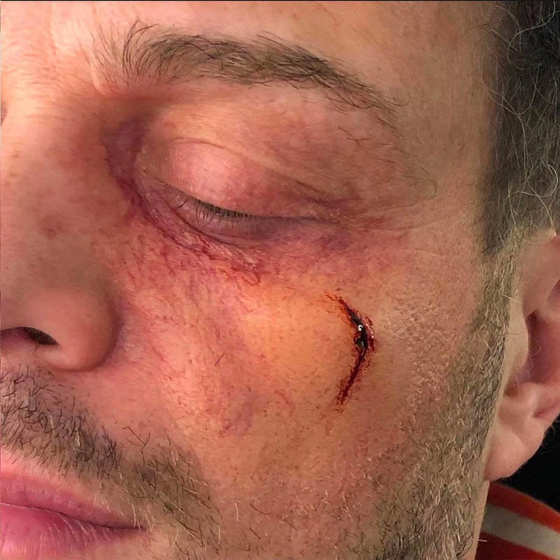 OCCHIO GONFIO Sinistro 5 OCCHIO GONFIO Sinistro - immagine 3