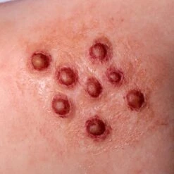 PROSTESI PUSTOLE IN SILICONE -Negozio Di Trucchi Per Effetti Speciali 800x800 stupr3152 prostesi pustole in silicone 2