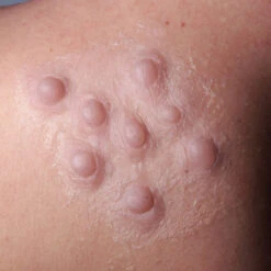 PROSTESI PUSTOLE IN SILICONE -Negozio Di Trucchi Per Effetti Speciali 800x800 stupr3152 prostesi pustole in silicone 3